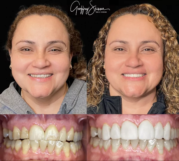 Sandra's New Down Teeth