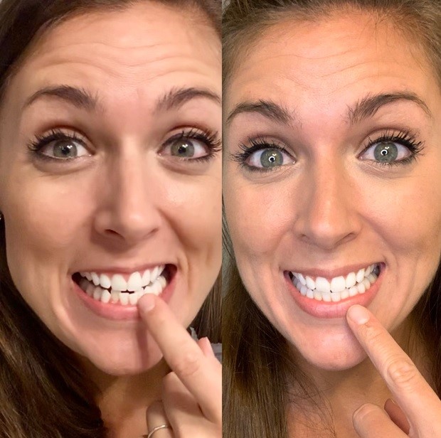 Woman pointing at straight white teeth